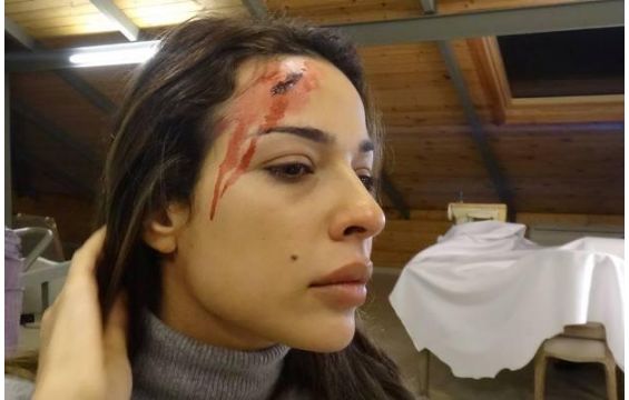 بالصورة: من طعن نادين نسيب نجيب بالسكين في وجهها؟